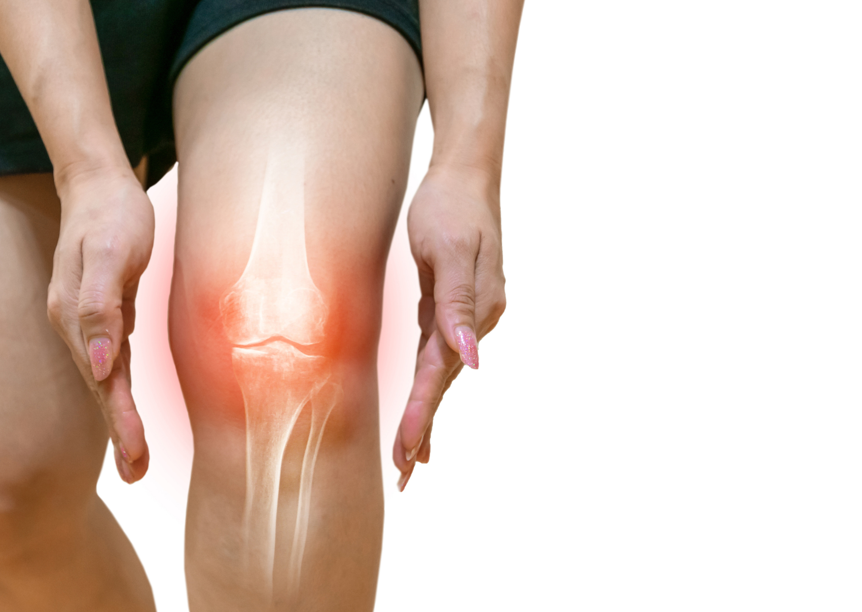 La protesi monocompartimentale di ginocchio