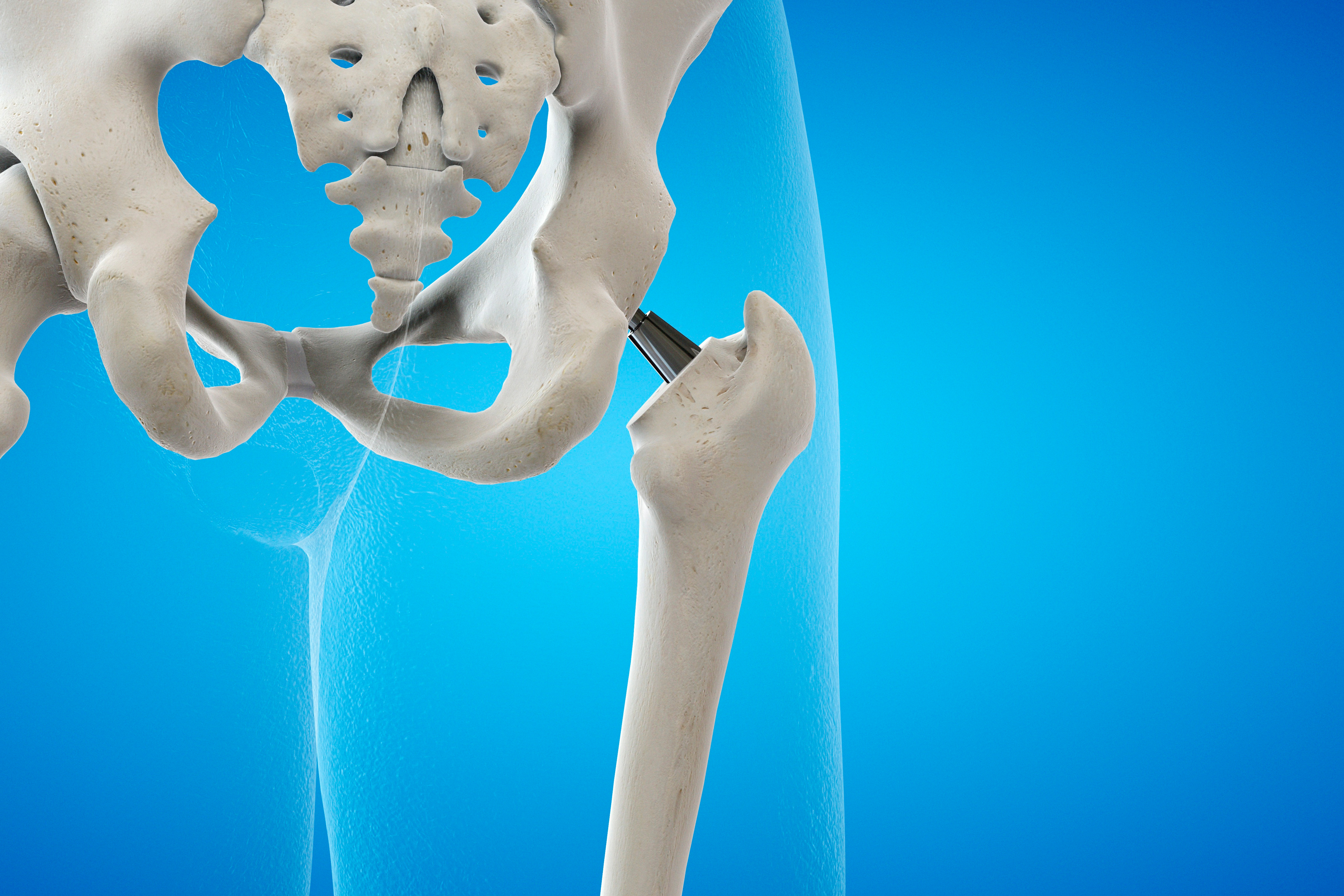 Protesi di anca: diagnosi, sintomi e trattamento