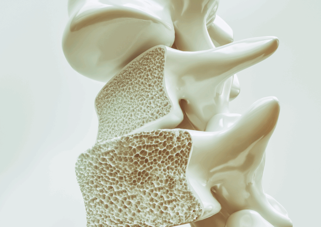 Rendering 3D realistico di una sezione della colonna vertebrale con evidenti segni di osteoporosi: le vertebre mostrano una struttura interna porosa e indebolita, simbolo della ridotta densità minerale tipica di questa patologia ossea. Trattamenti con limfa Therapy per osteoporosi con i Fisioterapisti della FIsioClinic del Centro Colombo GEnova