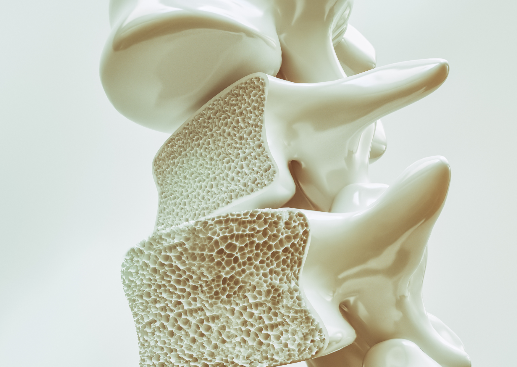 Osteoporosi: Come Riconoscerla e Trattarla
